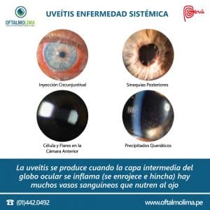 Uveítis enfermedad sistémica