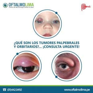 Tumores en el ojo