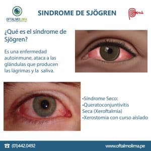 El síndrome de Sjögren