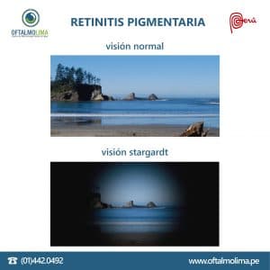 Retinitis pigmentaria