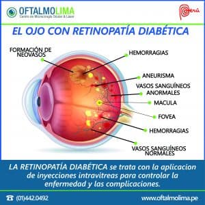 El ojo con retinopatía diabética