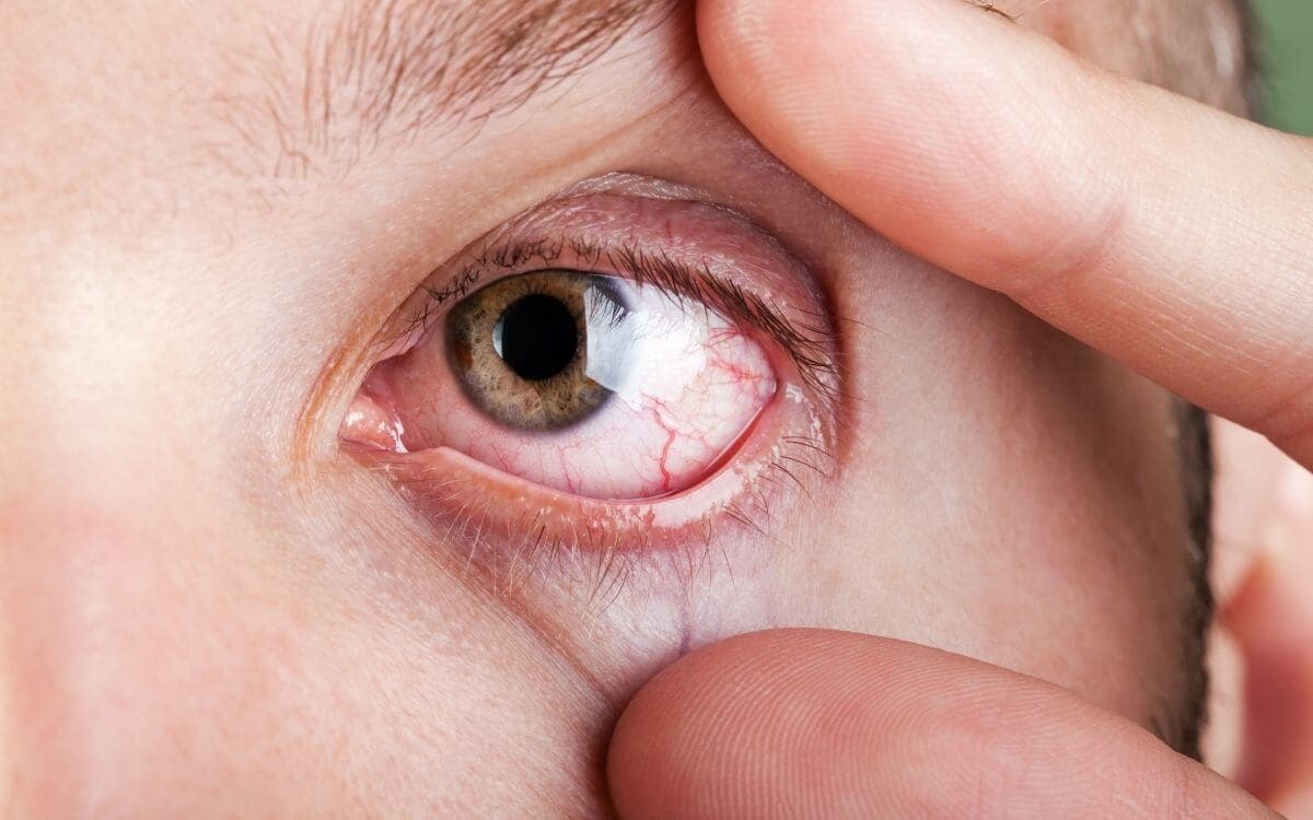 Enfermedades Oculares Comunes