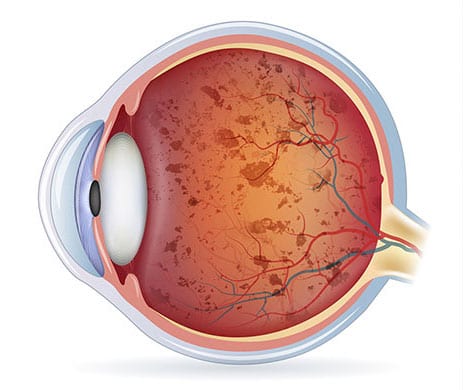 Retinitis Pigmentaria: causas, síntomas, diagnóstico y tratamiento
