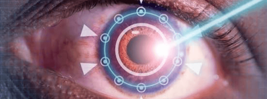 ¿Qué es el láser de femtosegundo?