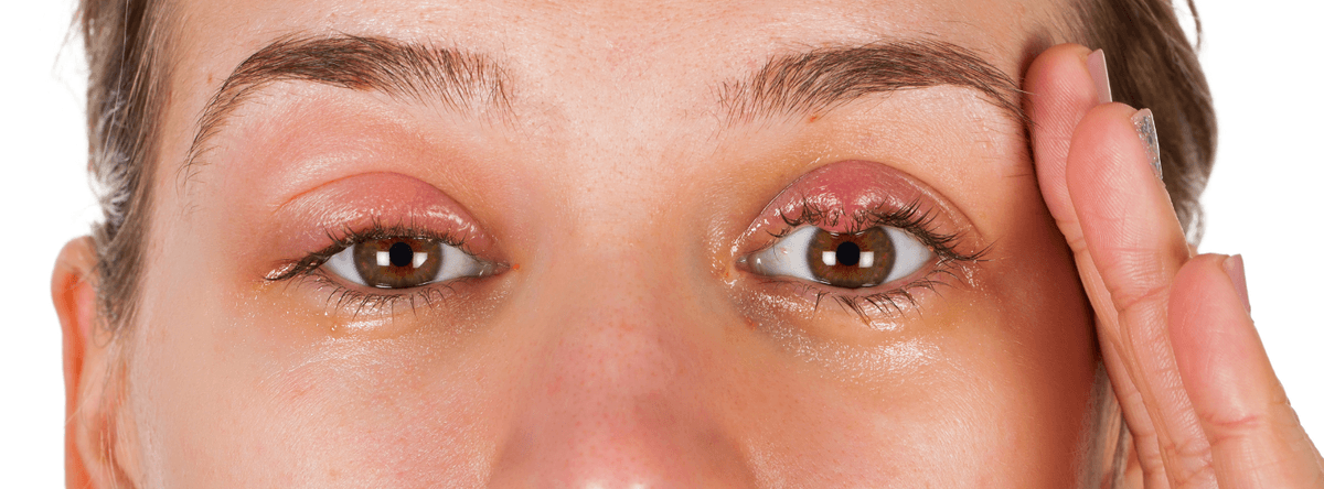 chalazion