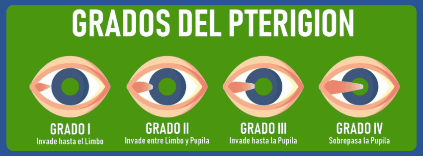 pterigión