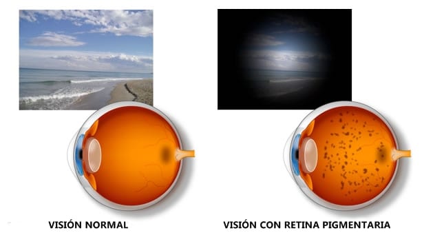 Síntomas de la retinitis pigmentaria