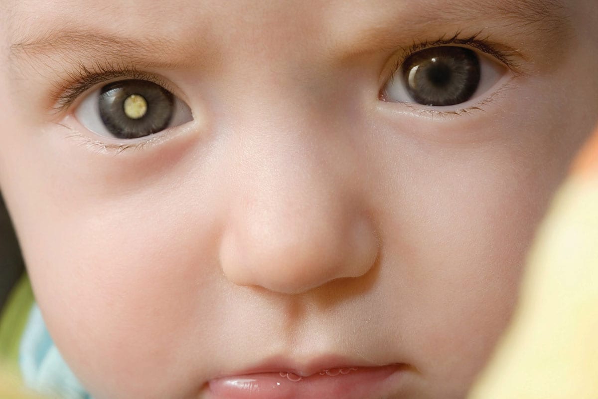 Enfermedades oculares hereditarias más comunes