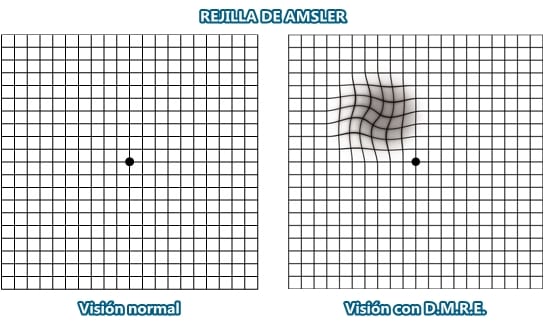¿Cómo se detecta la D.M.R.E?