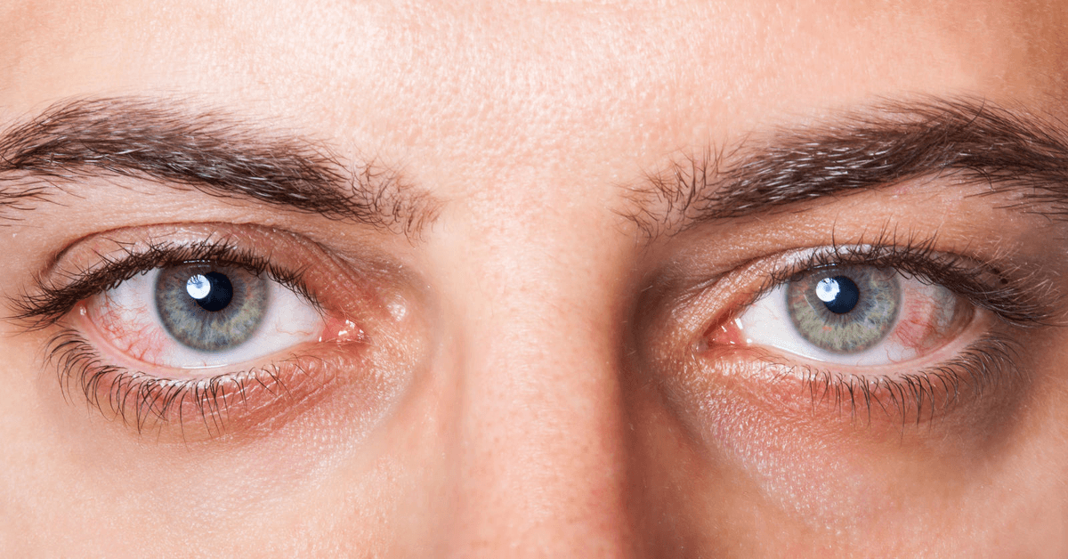 Síndrome del Ojo Seco: Irritación y Sequedad: Enfermedades Oculares Comunes