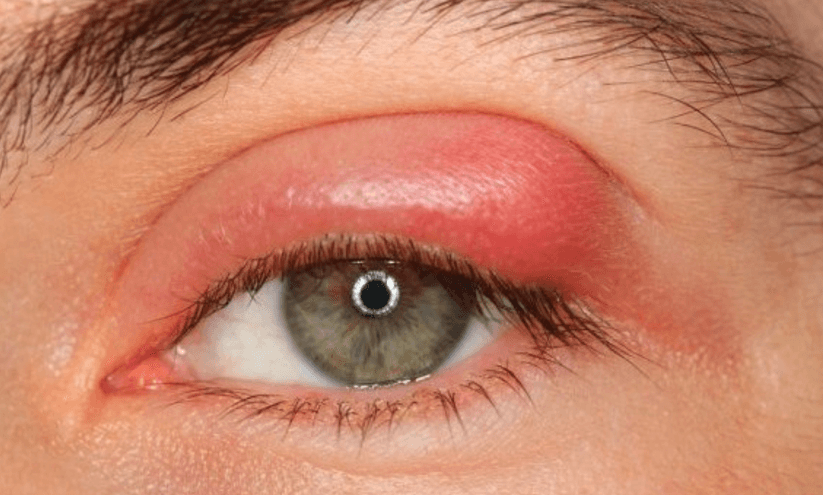 Infecciones Oculares