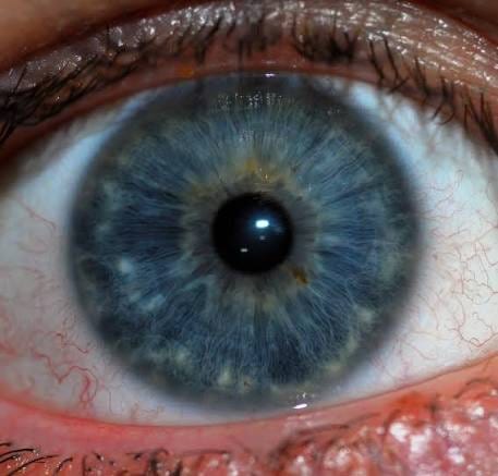 ¿Qué es el cáncer ocular?