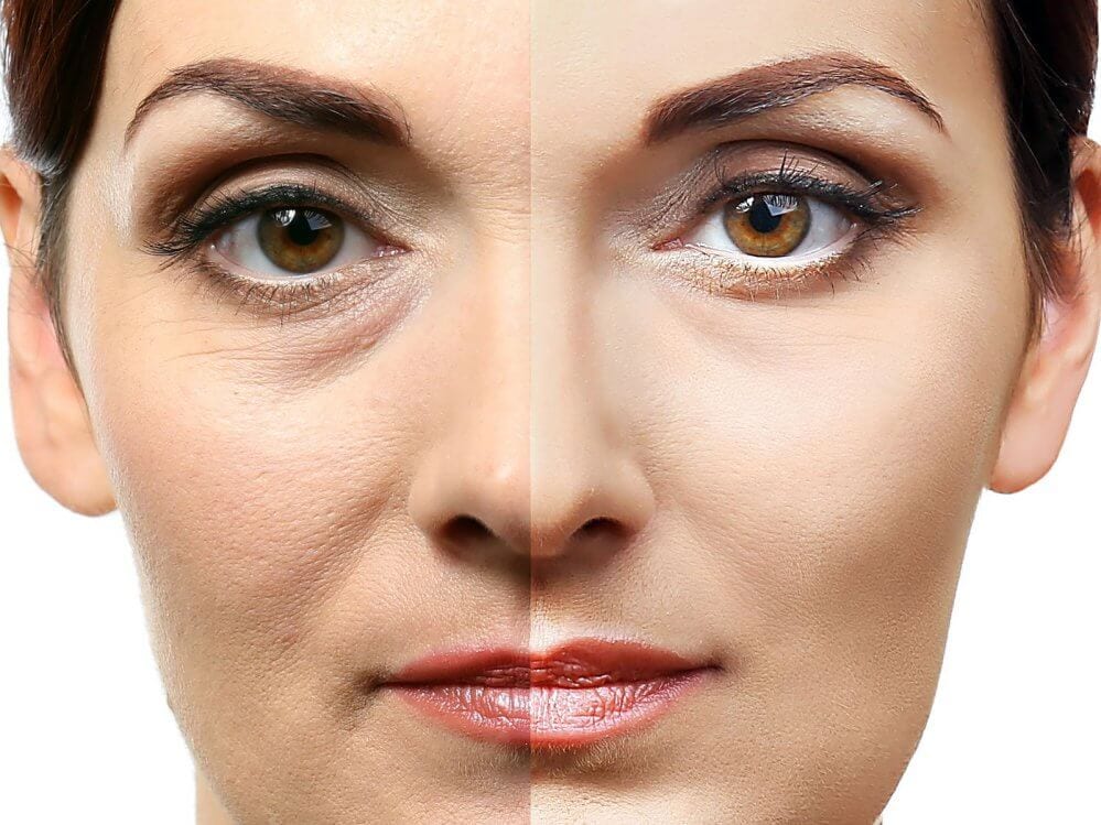 ¿Qué es la Blefaroplastia?