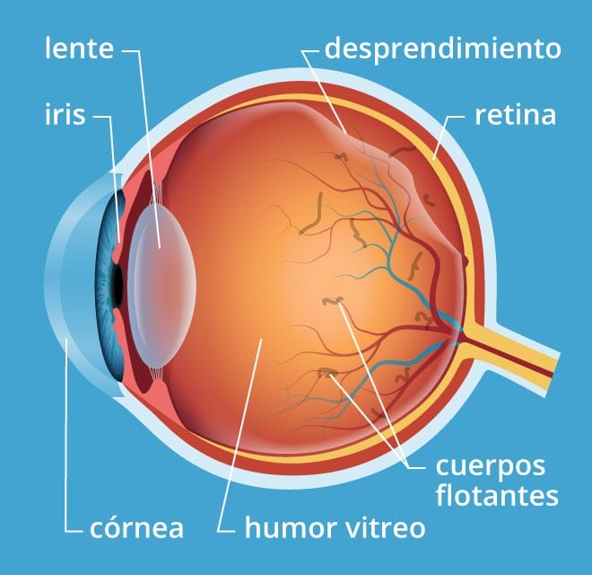 Desprendimiento Posterior de Vítreo: causas, síntomas y tratamiento
