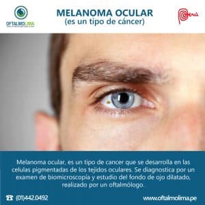 Melanoma Ocular