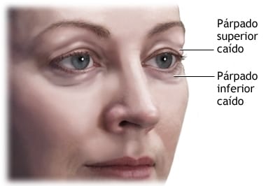 Blefaroplastia: exceso de piel y bolsas en los ojos