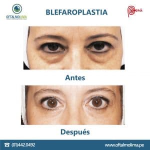 Blefaroplastia