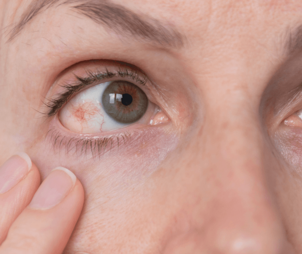 Cómo la Hipertensión Afecta la Salud Ocular