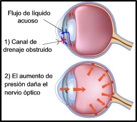 Conozca los síntomas de presión alta en los ojos
