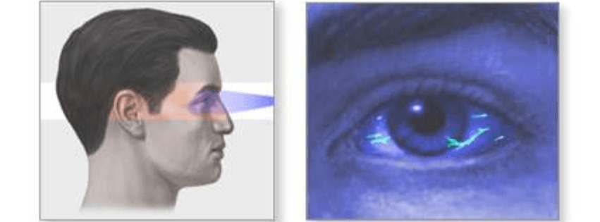 ¿Qué es el Test de Fluoresceína?