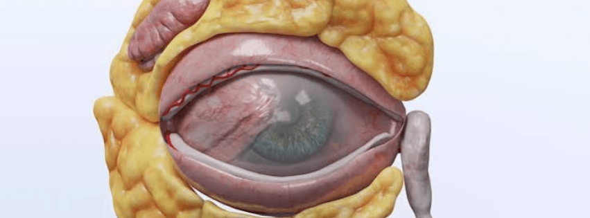 Pterigión Bilateral: causas, síntomas y tratamiento