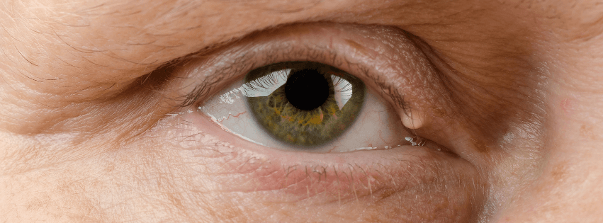 Quiste Sebáceo Palpebral vs Chalazión: diferencias y tratamiento