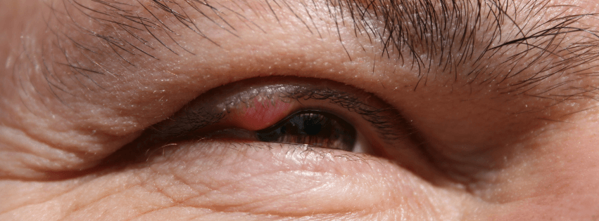 CHALAZION