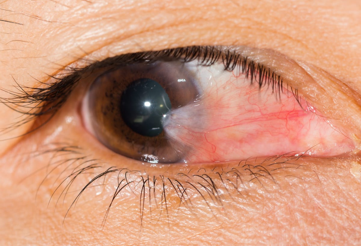 Ojos secos o sensación de arena