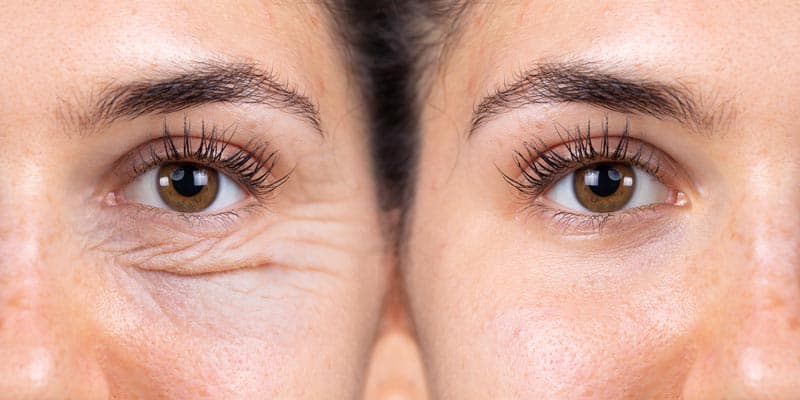 Blefaroplastia: exceso de piel y bolsas en los ojos