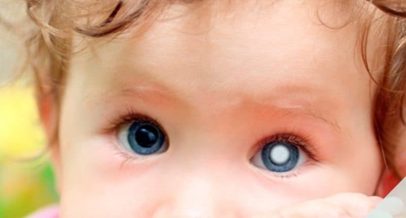 Catarata Infantil: causas, síntomas, tratamiento y cirugía
