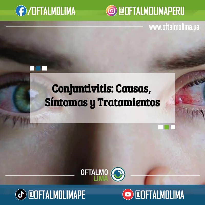 Conjuntivitis: Causas, Síntomas y Tratamientos