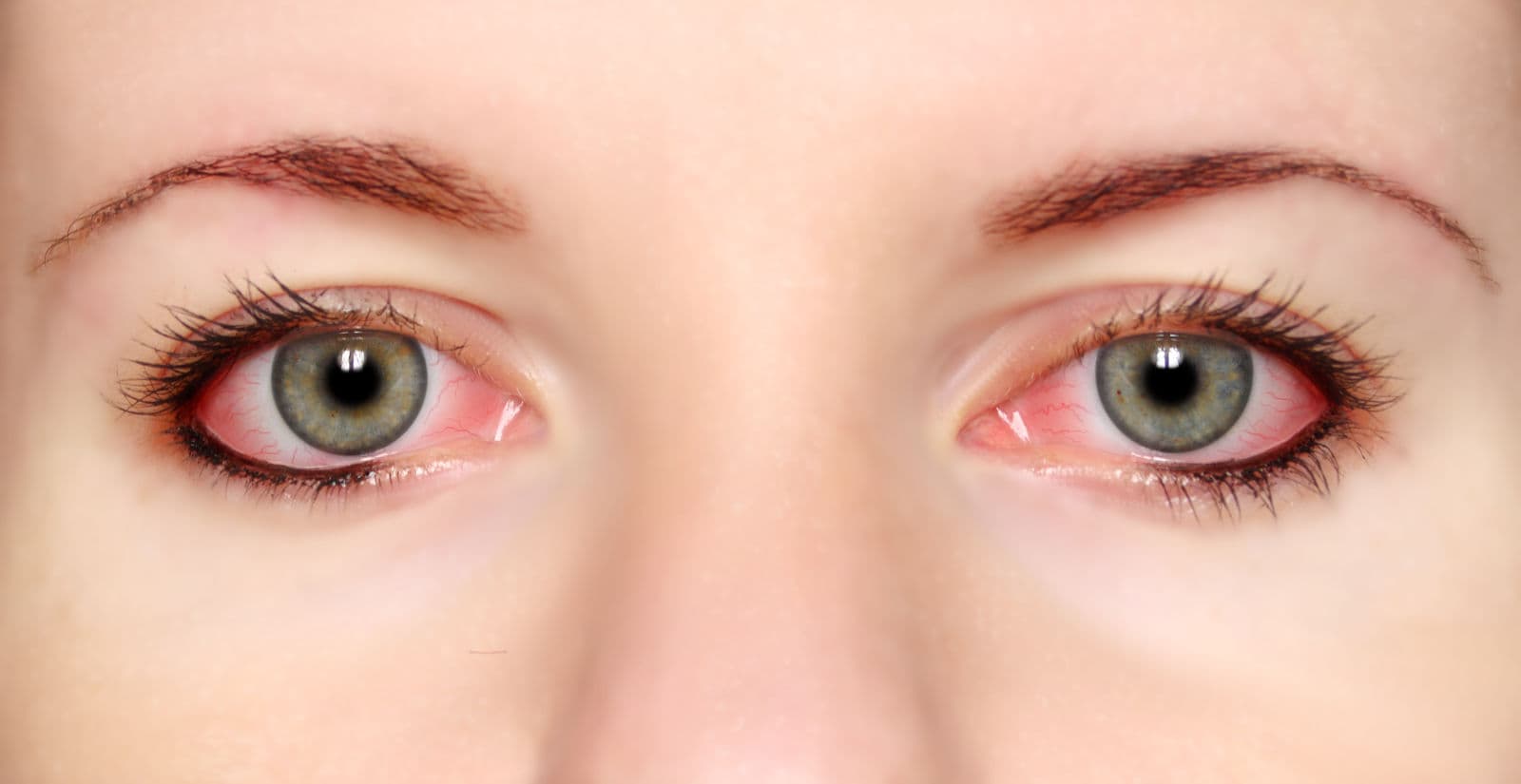 Conjuntivitis: síntomas, causas, prevención, tratamiento.