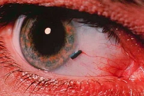 Causas del Traumatismo Ocular
