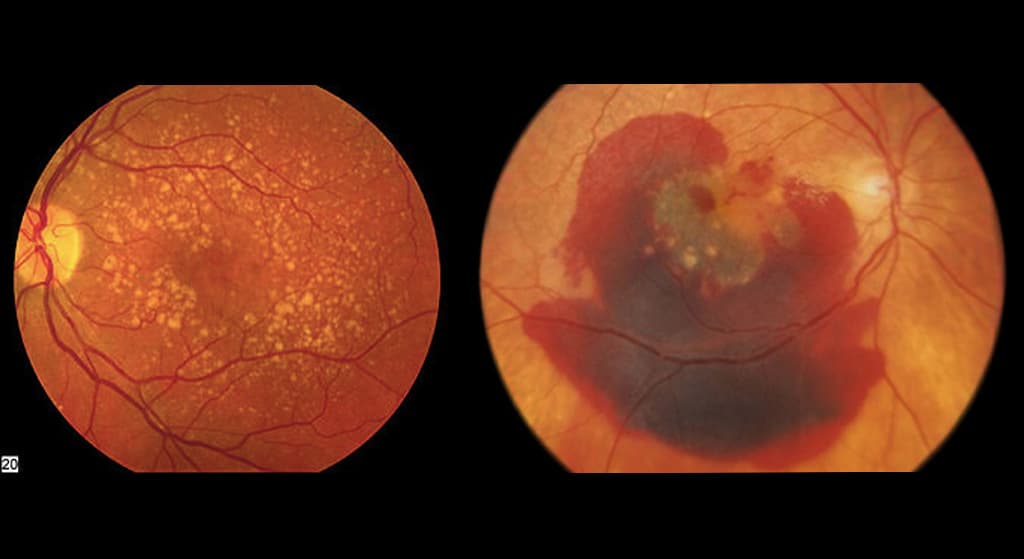 Degeneración Macular Relacionada con la Edad (D.M.R.E.)