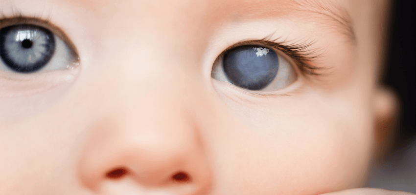 Catarata Infantil: causas, síntomas, tratamiento y cirugía