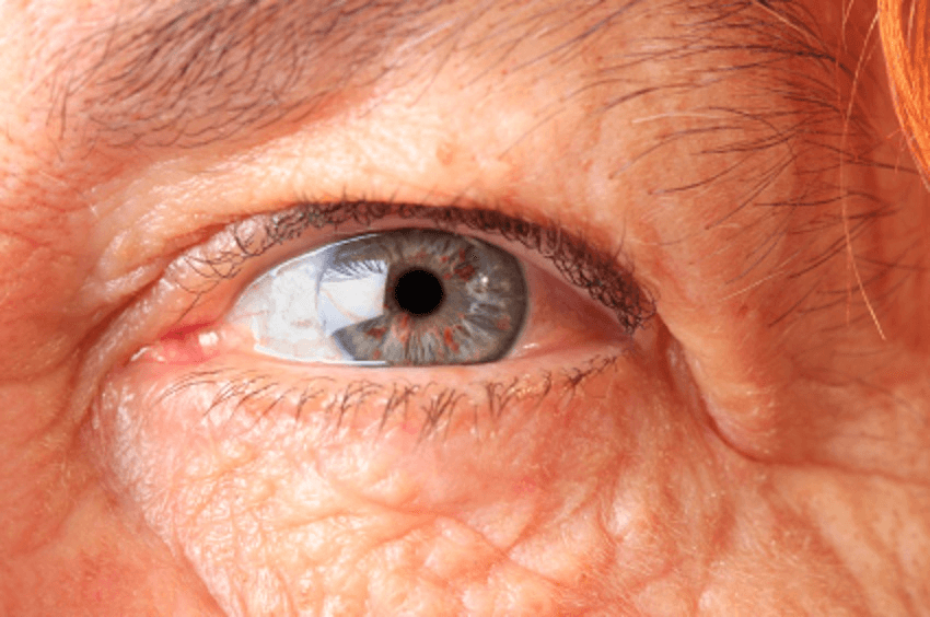 Degeneración Macular