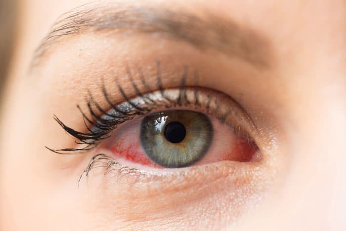 ¿Qué es el Ojo Seco?
