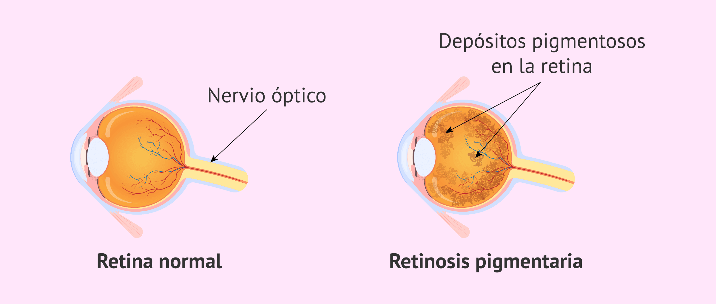 Retinitis Pigmentaria: causas, síntomas, diagnóstico y tratamiento