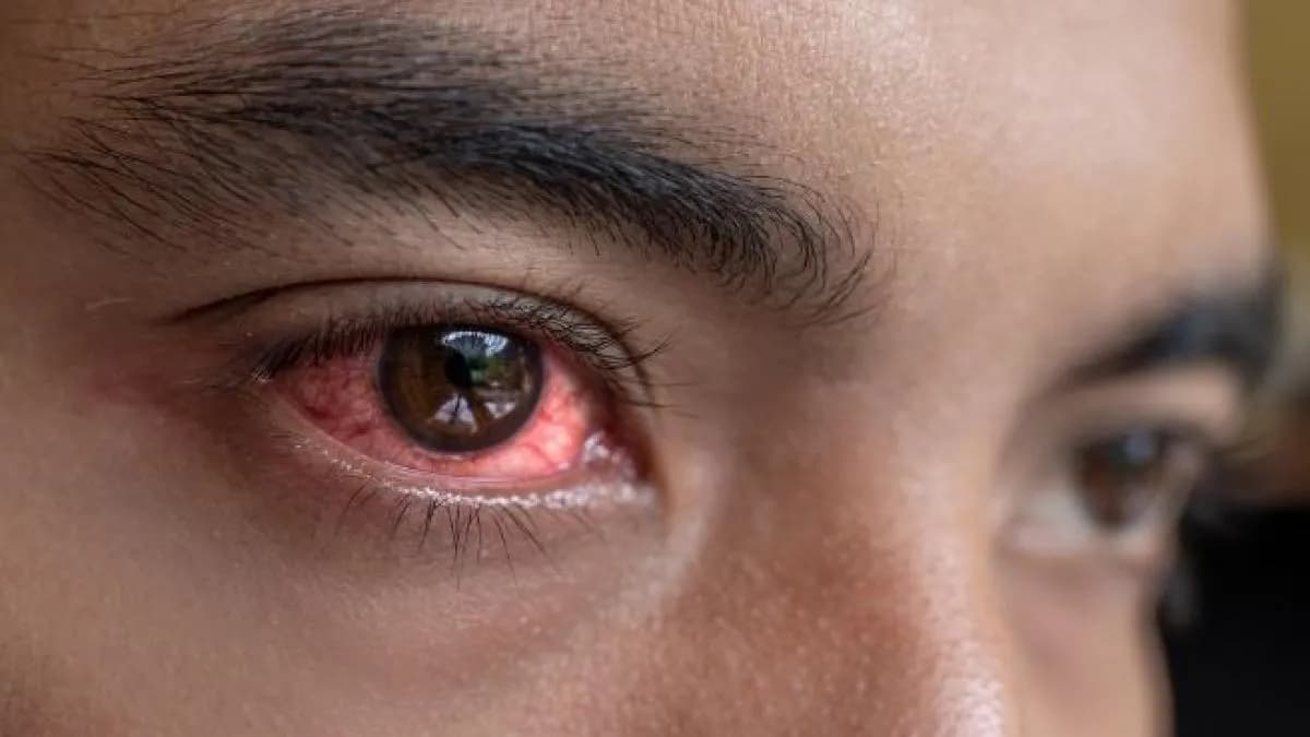 Tracoma: principal causante de ceguera a nivel mundial