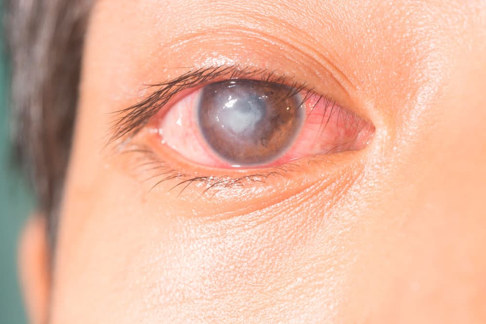 Traumatismo Ocular: tipos, causas, síntomas y tratamiento