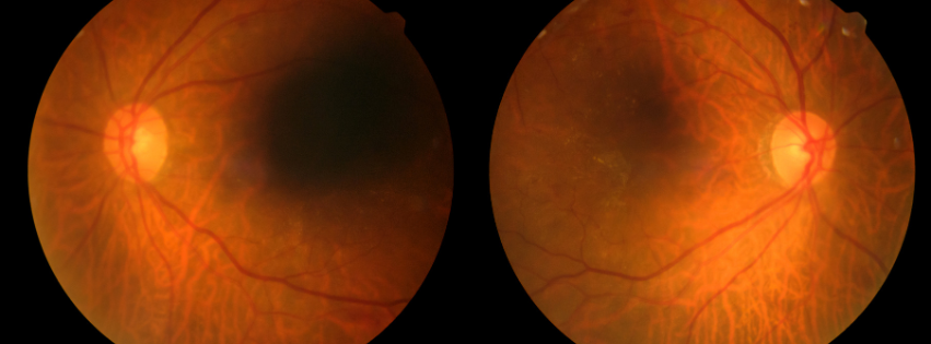 retinopatia diabetica