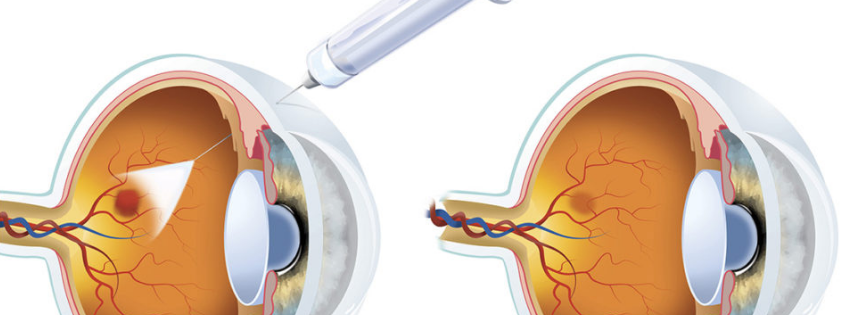inyección intravitrea