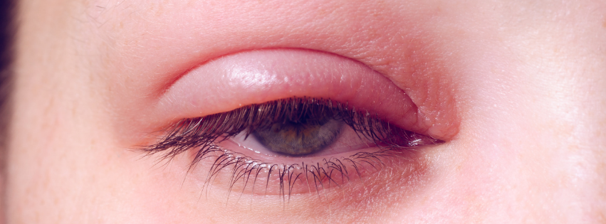 chalazion