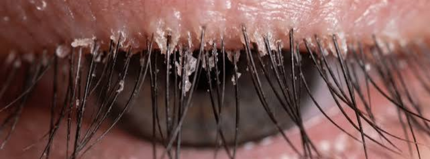 examen demodex