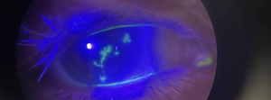 TEST DE FLUORESCEINA